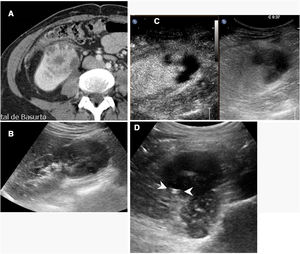 Right kidney abscess. A) Computed tomography shows a heterogeneous image in the lower pole of the kidney, with fluid areas. A decision was made to perform percutaneous drainage. B) The ultrasound shows a hypoechoic lesion, but does not clearly identify the fluid area, complicating the guidance of the procedure. C) Contrast-enhanced ultrasound identified the abscess area, which did not enhance, and guided the procedure towards it. D) The catheter (arrow tips) is inside the cavity. The patient recovered quickly.