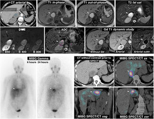 Pheochromocytoma as an almost purely haemorrhagic mass demonstrated by Nuclear Medicine. 58-year-old female. Went to the Accident and Emergency Department with headache and palpitations. Top: CT and MRI. Two adrenal nodules (elliptical ROI on CT), a larger right one, with mean attenuation values somewhat lower than 20 HU, nonspecific, and a smaller left one of -1.4 HU, characterised as a lipid-rich adenoma. The MRI shows that the right lesion (arrowheads) is an almost purely haemorrhagic lesion, with a high signal on T1, without a drop in signal out-of-phase in the interior or in its periphery. The left adrenal adenoma (arrows) does lose signal intensely out-of-phase (a montage of images has been made to show the centre of the two lesions in the same image). The right adrenal lesion shows a high signal on T2, with two fluid levels, which can also be seen in the diffusion-weighted sequence and in the ADC map, with progressively greater restriction of diffusion towards gravitational areas. In the wall of this lesion, the mean ADC values are 0.95 × 10−3 mm2/s. The adenoma has mean values of 1.17. As in other haemorrhagic lesions, recognition of parietal or nodular enhancements is facilitated by subtracting the baseline image. Bottom: scintigraphy and SPET/CT findings with (123I) MIBG. The scintigraphy study shows uptake by the right lesion (arrowheads), more evident in the study 24 h after the administration of the radiopharmaceutical. The SPECT-CT study with the same radiopharmaceutical acquired at 6 h shows the uptake by the lesion more clearly, virtually confirming the diagnosis of pheochromocytoma. The left adenoma does not enhance.