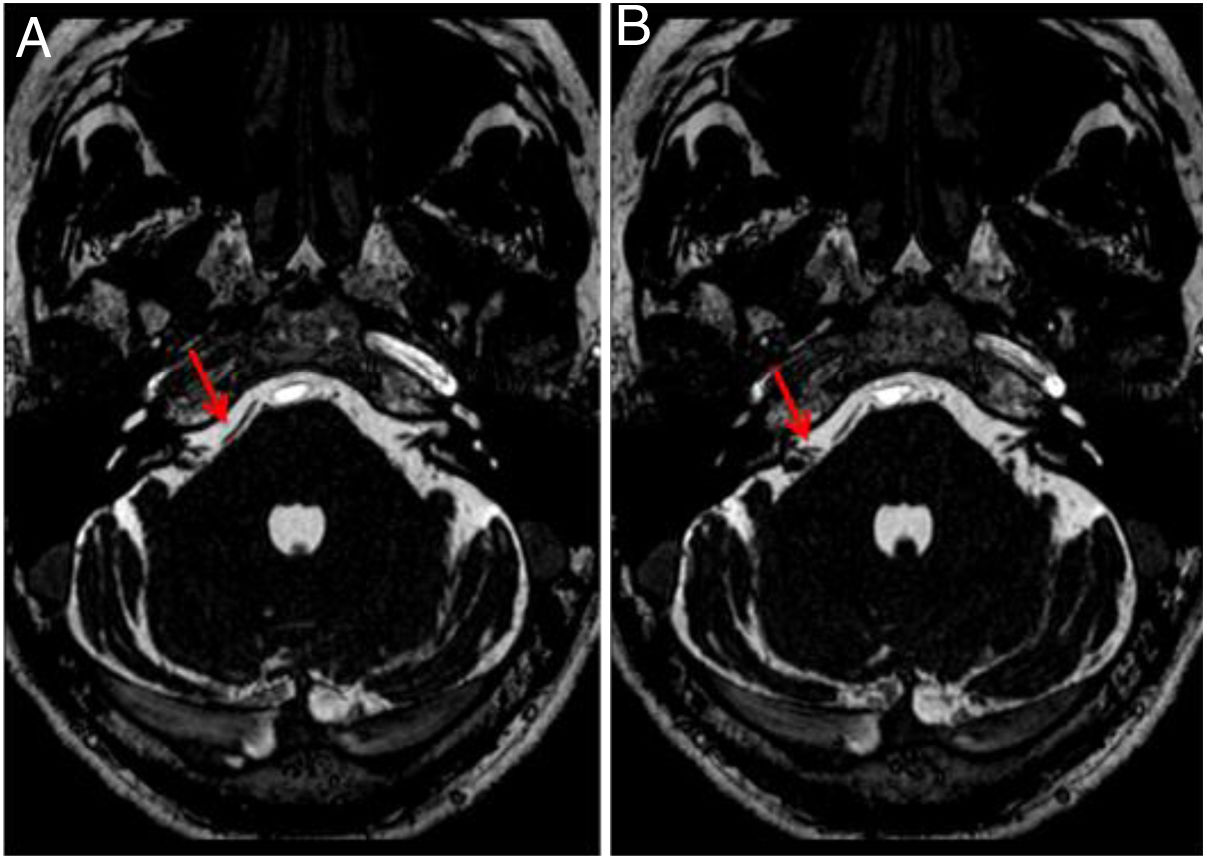 Vascular loop in the cerebellopontine angle: Clinical-radiological ...