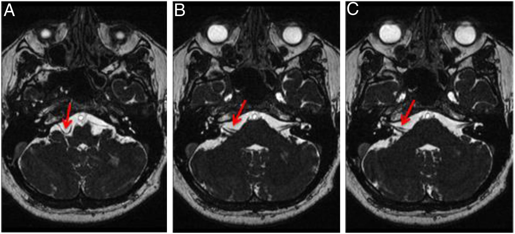 Vascular loop in the cerebellopontine angle: Clinical-radiological ...