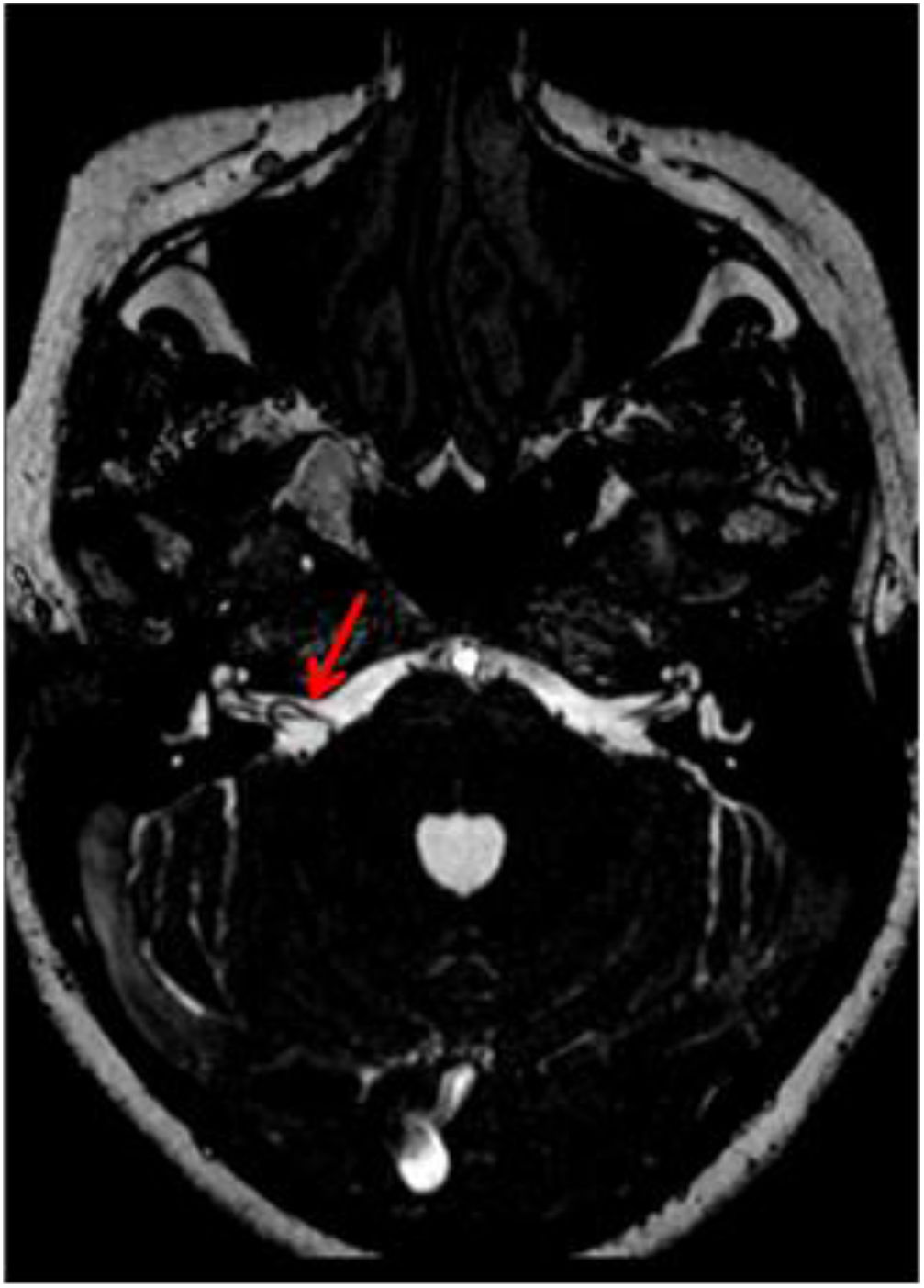 Vascular loop in the cerebellopontine angle: Clinical-radiological ...