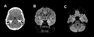 Eleven-year-old male with 2-day history of symptoms of fever, headache, behavioural changes, vertigo, vomiting and altered gait. Computed tomography (A) of the brain showed a bilateral poorly defined hypodense area in the temporal lobes adjacent to the amygdala. These findings were confirmed on an MRI performed three days later, where the oedema appears as hyperintense areas on T2 and FLAIR (B and C). No contrast enhancement was observed.