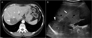 A) Contrast-enhanced computed tomography showing hypodense space-occupying lesion (SOL) in liver segment VII (arrow). B) Liver biopsy. Coaxial needle (arrow) that crosses the liver parenchyma until reaching the SOL (arrowhead).