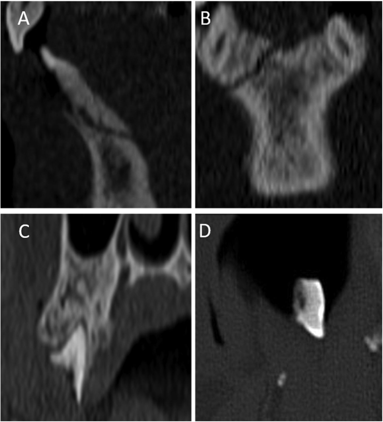 CT findings for dental disease | Radiología (English Edition)