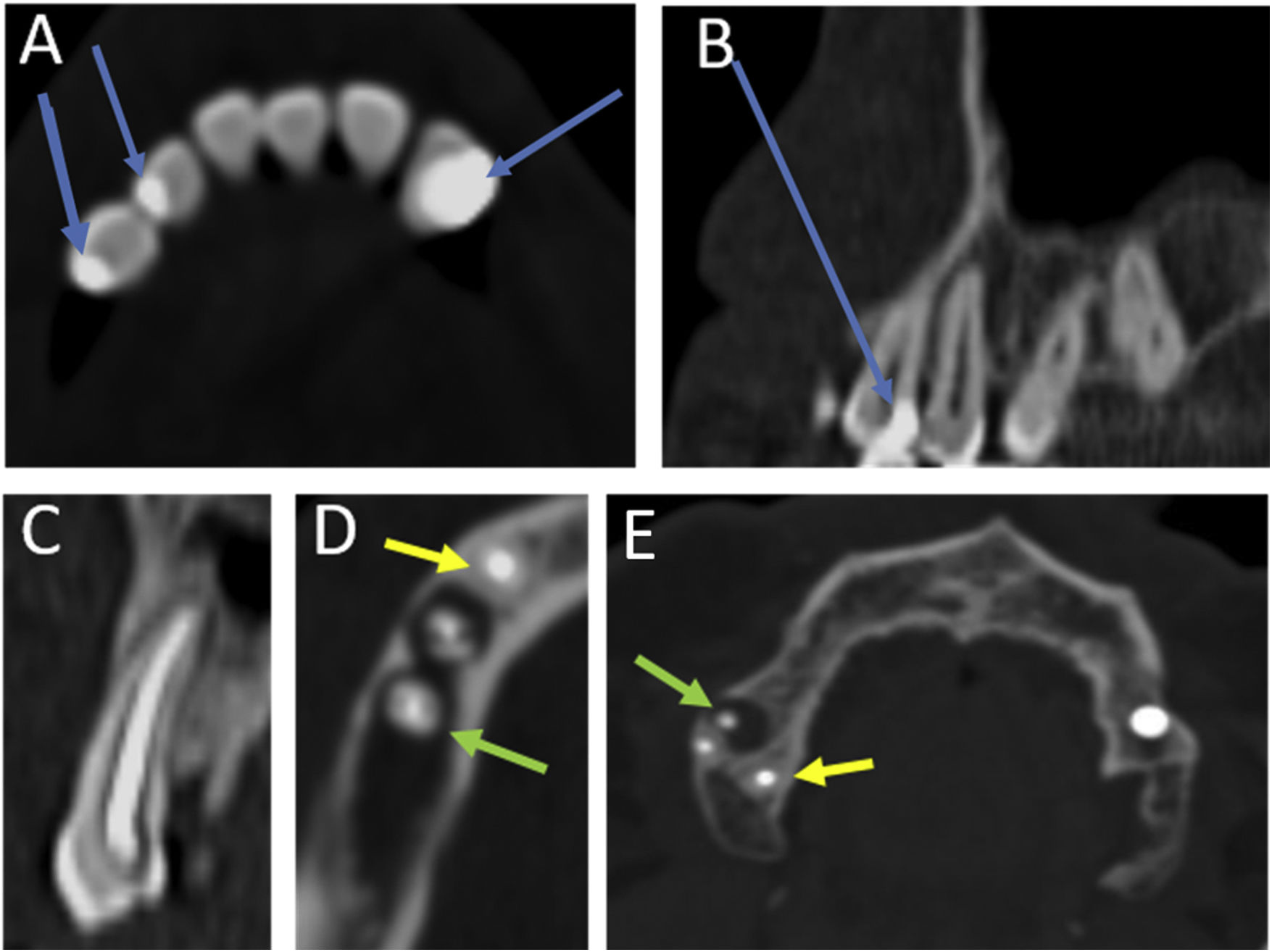 Mri Infected Tooth CT findings for dental disease | Radiología (English Edition)
