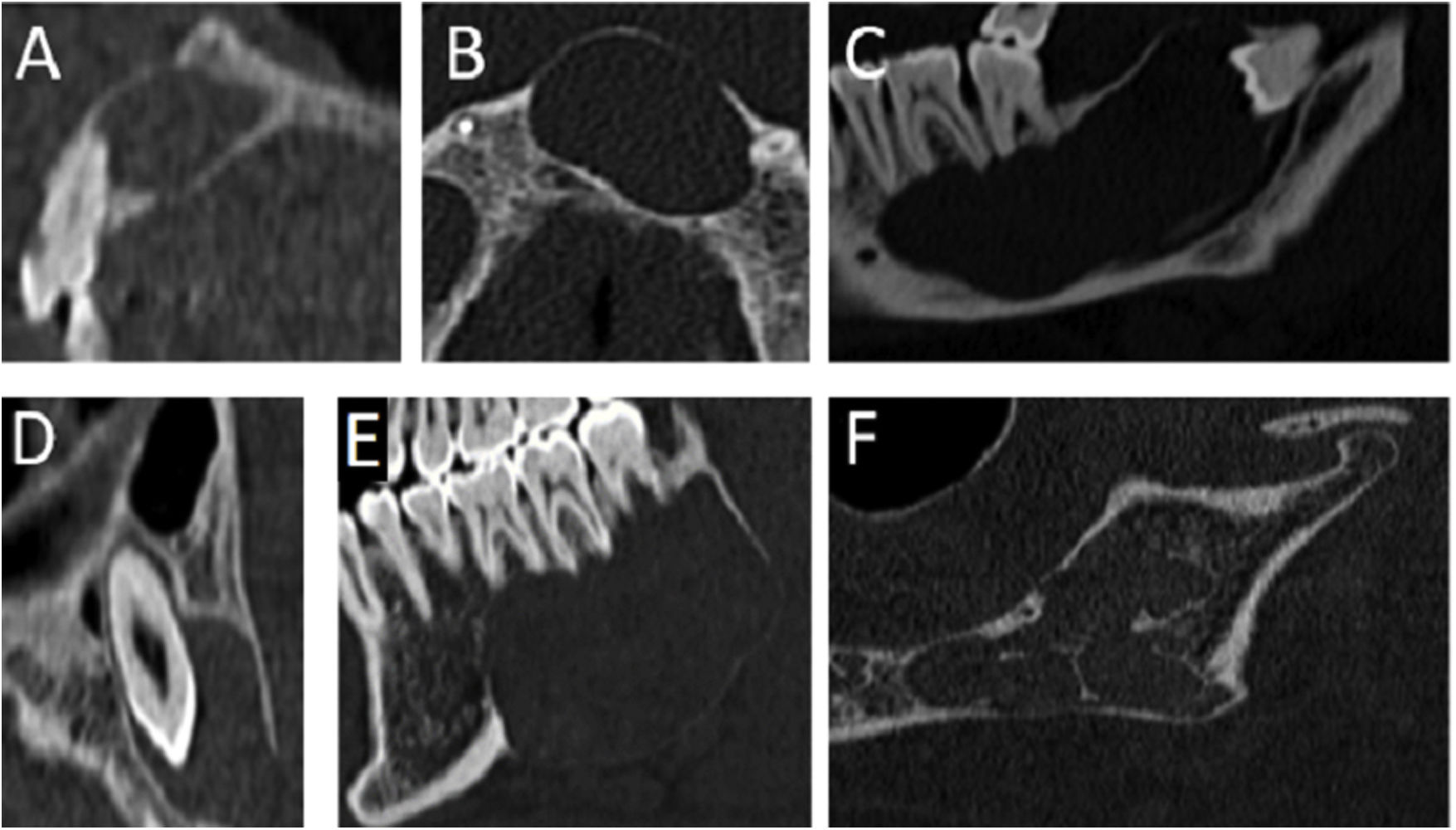 CT findings for dental disease | Radiología (English Edition)