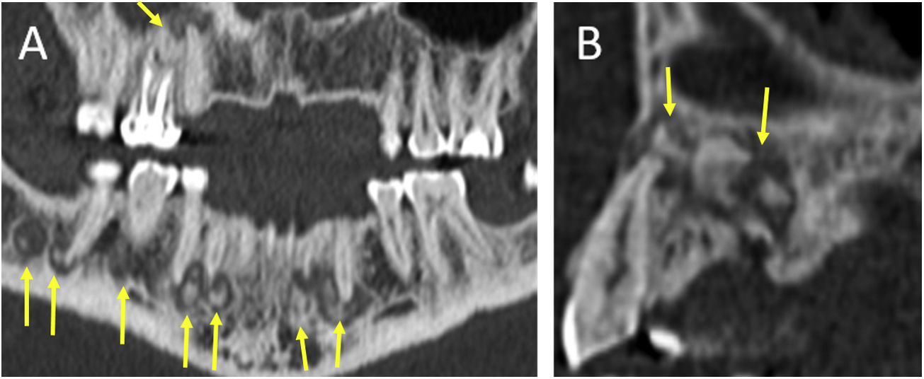 CT findings for dental disease | Radiología (English Edition)