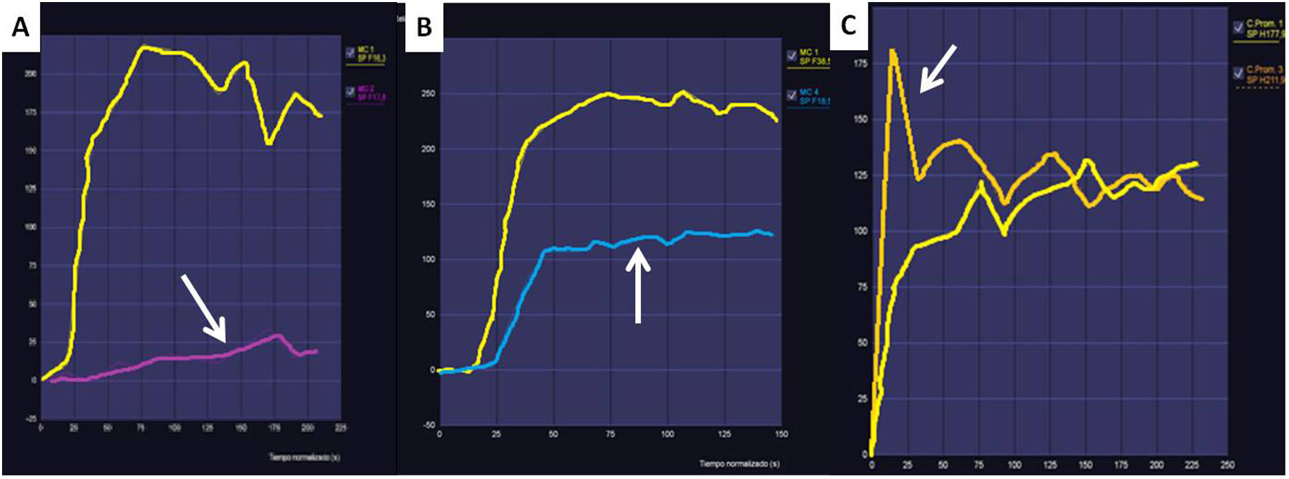 The O-RADS MRI score for the characterization of indeterminate ovarian ...