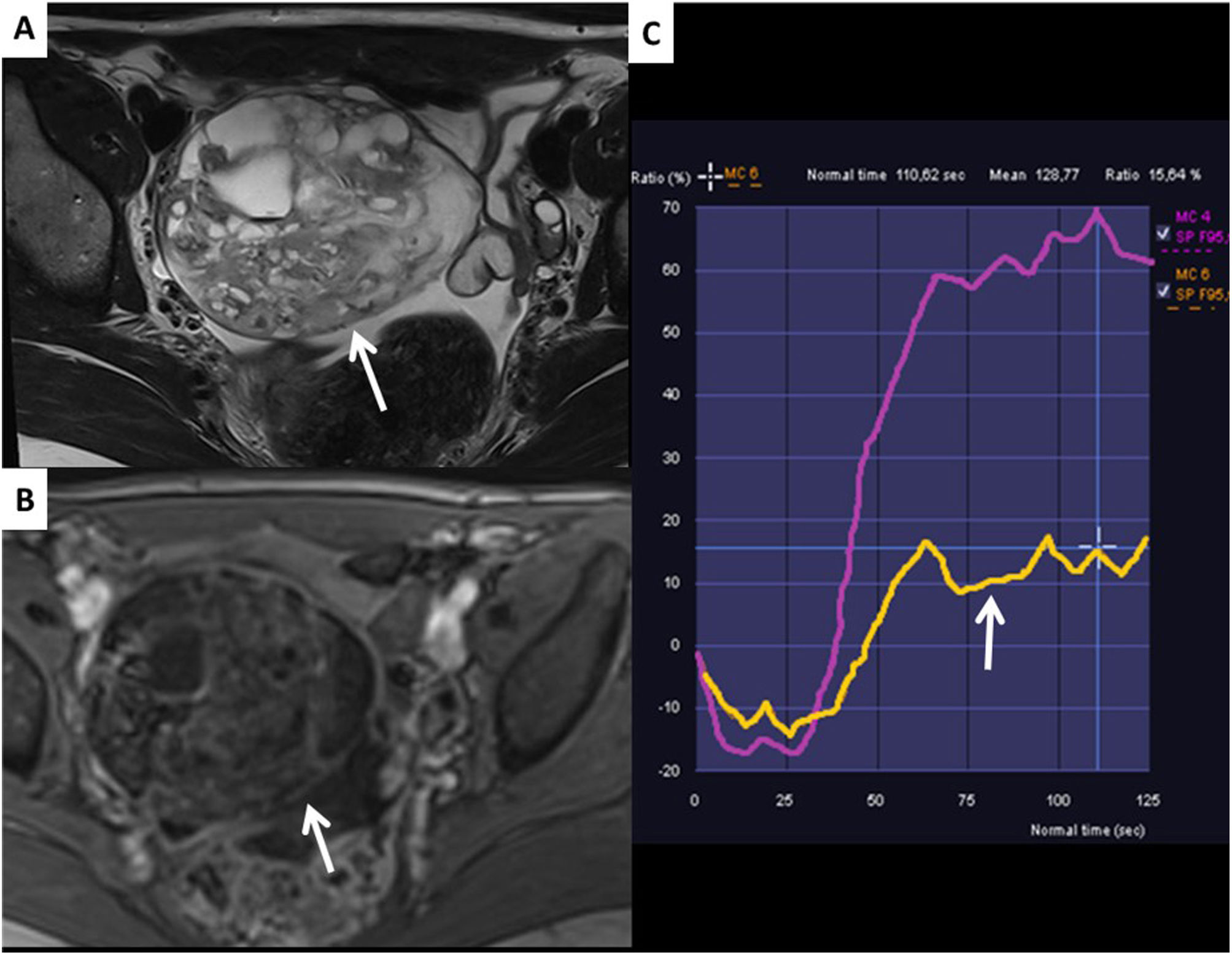 The O-RADS MRI score for the characterization of indeterminate ovarian ...