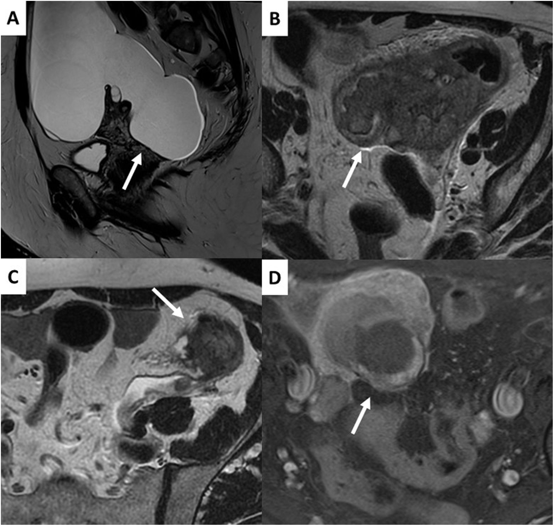 The O-RADS MRI score for the characterization of indeterminate ovarian ...