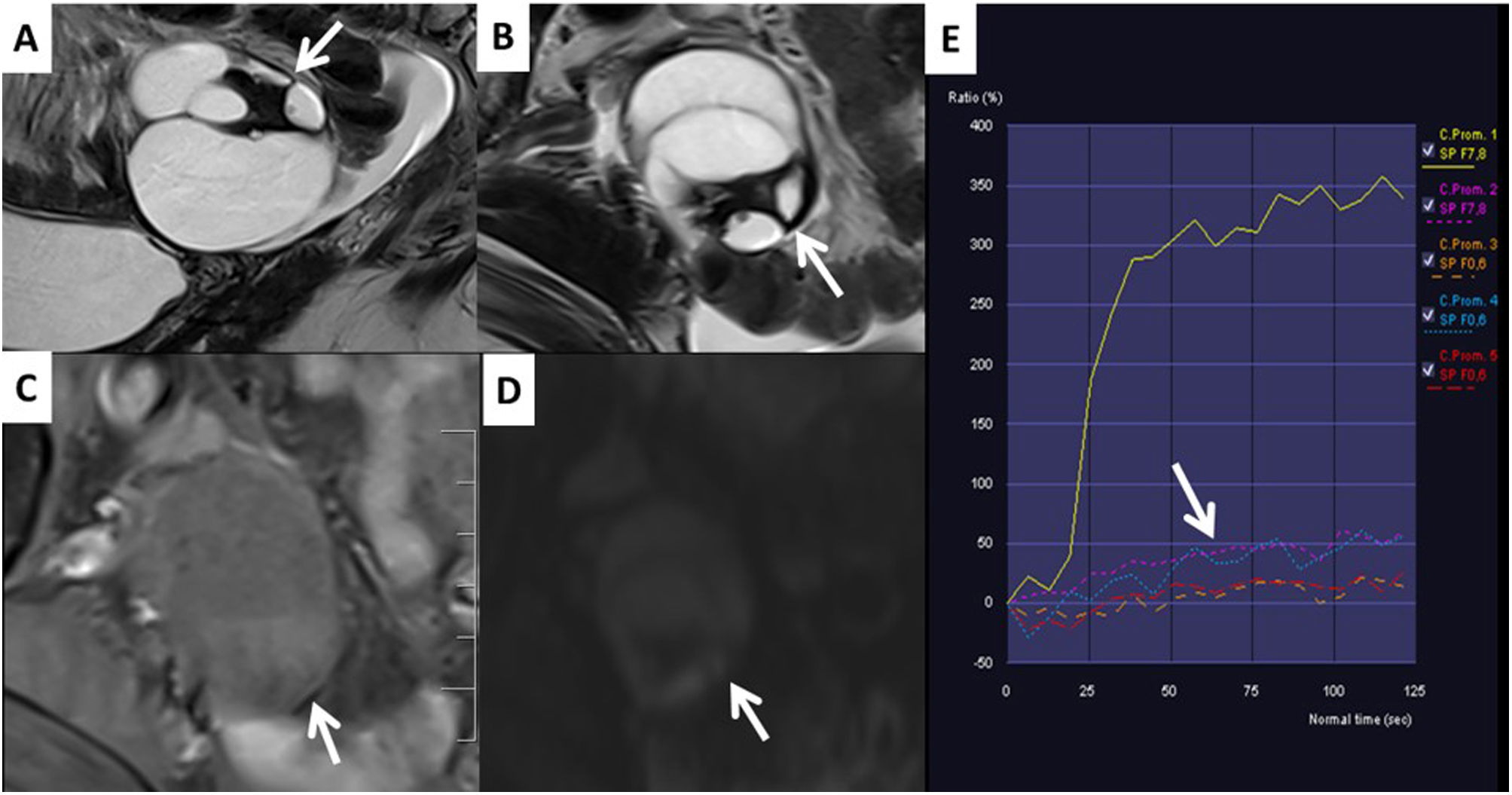 The O-RADS MRI score for the characterization of indeterminate ovarian ...