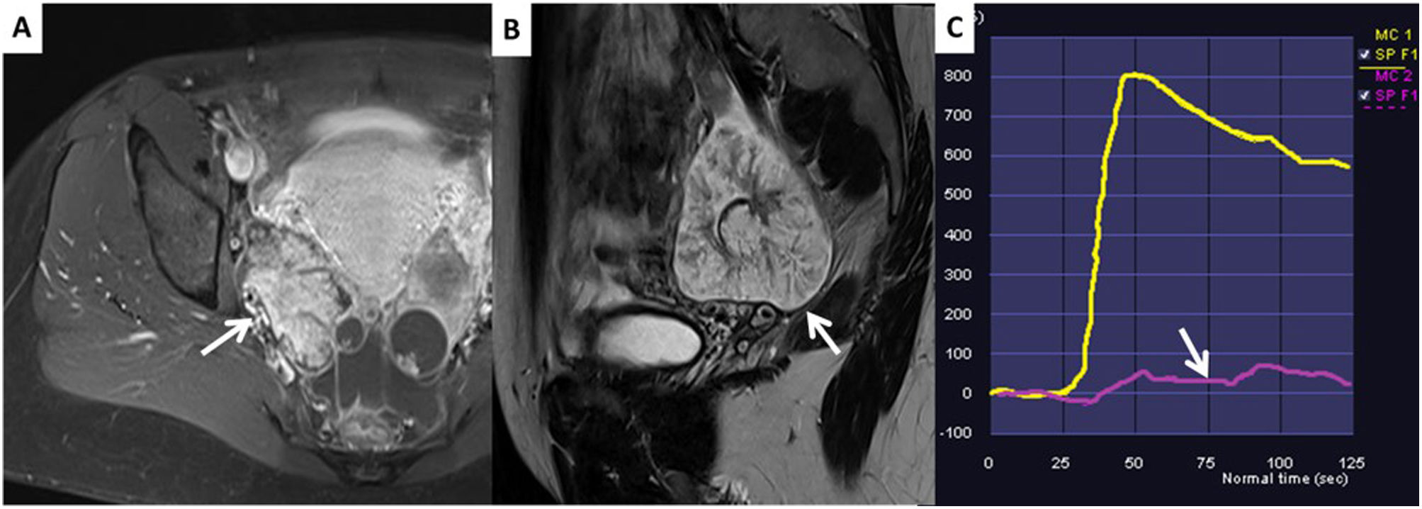 The O-RADS MRI score for the characterization of indeterminate ovarian ...