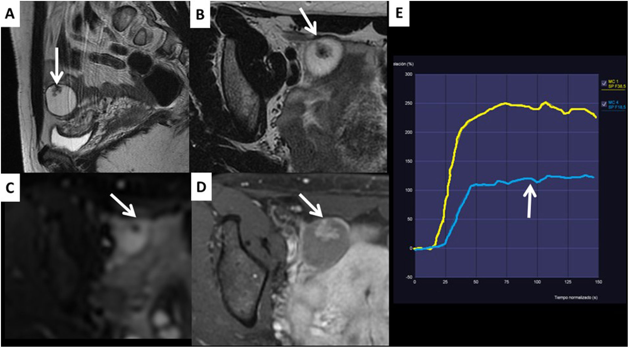 The O-RADS MRI score for the characterization of indeterminate ovarian ...