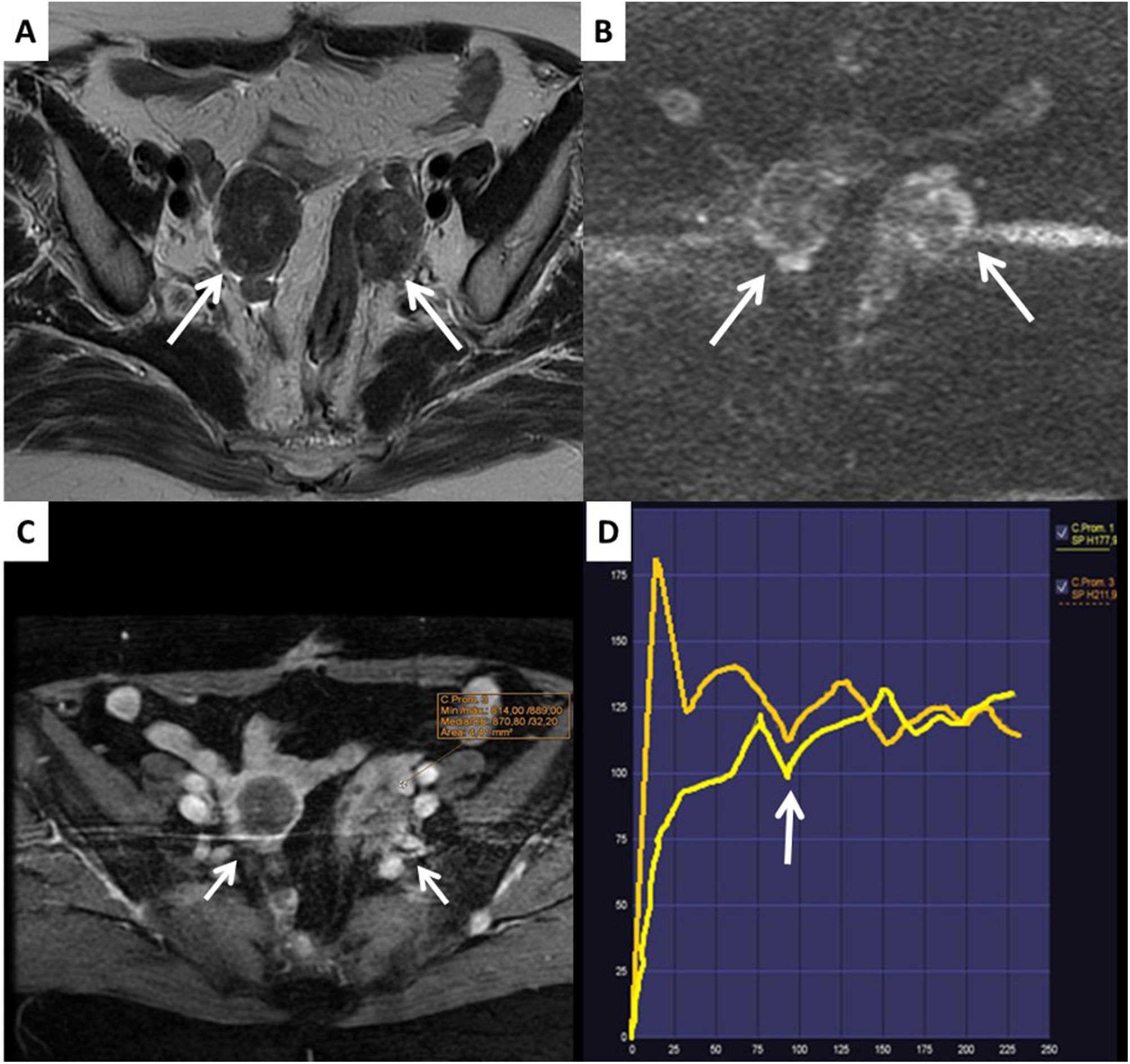 The O-RADS MRI score for the characterization of indeterminate ovarian ...