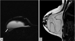 Breast magnetic resonance imaging. (A) Silicone-only sequences showing a posterior and external image with the same signal intensity as silicone as a result of intracapsular silicone gel bleed (white arrow). (B) Sagittal T2-weighted sequence with hypointense lines as a linguine sign in ICR.
