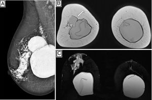 (A) MLO mammographic view of right breast with multiple hyperdense nodular images in the central region and towards the posterior plane. (B) MRI: Coronal T2-weighted sequence. Herniation of the right implant towards the UOQ (white arrow). (C) Bilateral ICR. MRI: Axial silicone-only sequence with hyperintense images in the central region of the breast extending towards the nipple, as a sign of ECR. MLO: mediolateral oblique; UOQ: upper outer quadrant.