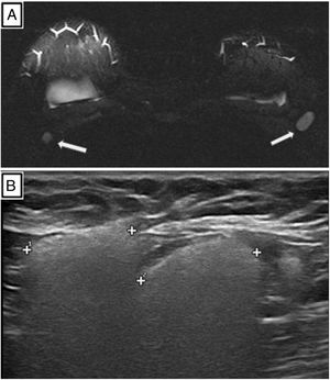 (A) Axial silicone-only sequence. Hyperintense lymph nodes in both axillas consistent with silicone infiltration (white arrows). (B) Axillary lymph nodes with a snowstorm appearance attributable to free silicone in the lymph nodes.
