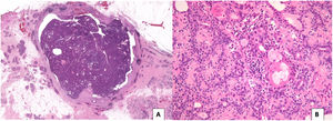 A) Circumscribed tumour lesion, surrounded by a fibrous capsule, made up of ovoid and rounded glandular structures, densely grouped, with papillary patterned areas (H-E, 10x). B) Glandular structures, with prominent myoepithelial cells, of epithelioid appearance and foci of mature squamous metaplasia and sebaceous metaplasia (H-E 200x).
