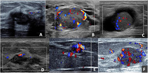 Adenomyoepitheliomas in colour Doppler mode. A) Oval, hypoechoic, circumscribed and non-vascularised nodule. B) Oval, hypoechoic, circumscribed nodule, presenting perinodular and intranodular vascularisation. C) Solid-cystic, oval nodule with intranodular vascularisation in the solid portion. D) Nodule with exclusively capsular vascularisation. E) Oval nodule, with marked vascularisation; the presence of a single pedicle leading to the nodule can be observed. F) Oval, hypoechoic nodule, with marked nodular and capsular vascularisation with the presence of multiple tortuous pedicles entering the nodule.