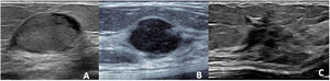 Adenomyoepithelioma of the breast on greyscale ultrasound. A) Complex oval nodule (solid with cystic areas) with circumscribed margins. B) Circumscribed hypoechoic, oval nodule. C) Hypoechoic nodule of irregular shape, with angled margins.