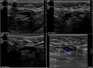 33-year-old patient with a diagnosis of grade 3 HER2-positive moderately to poorly differentiated invasive ductal carcinoma. Axillary ultrasound with four adenopathies with diffuse cortical thickening of more than 4 mm. Lymphadenectomy: 3/25 nodes with macrometastasis.