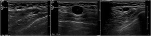 38-year-old patient diagnosed with grade 3 luminal B HER2-negative invasive ductal carcinoma. Axillary ultrasound with three adenopathies; one with cortical thickening of 4 mm and two with loss of hilum. Lymphadenectomy: 2/16 nodes with macrometastasis.