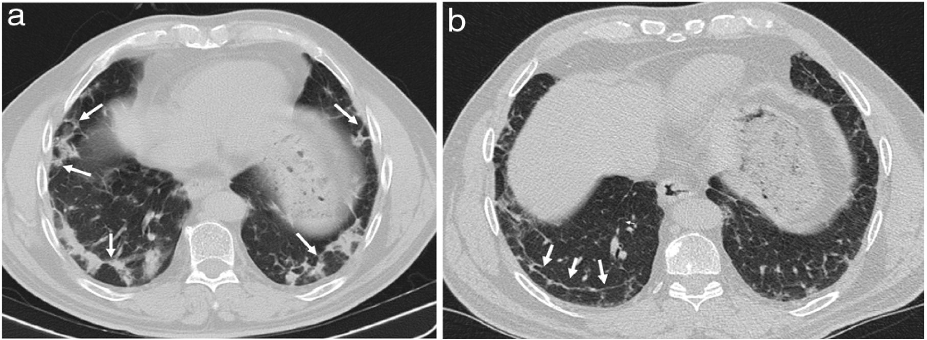 Organizing pneumonia | Radiología (English Edition)