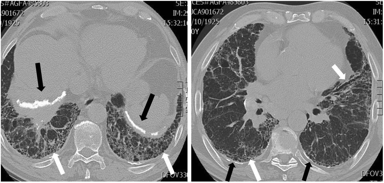 Basilar Reticular Pattern Inhalational lung diseases | Radiología (English Edition)