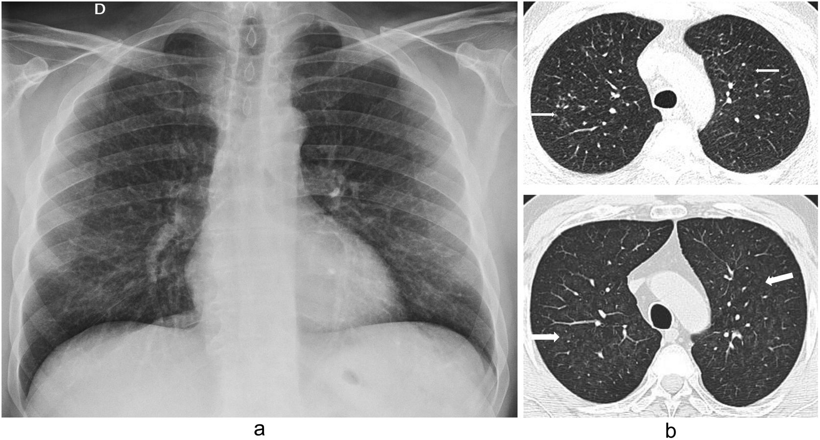 Lung Radiograph Patterns Inhalational lung diseases | Radiología (English Edition)