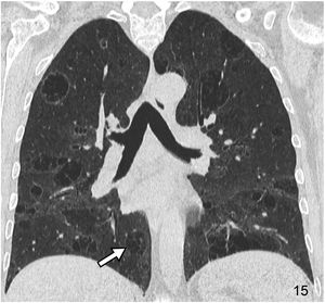 Basic HRCT patterns in diffuse interstitial lung disease | Radiología ...