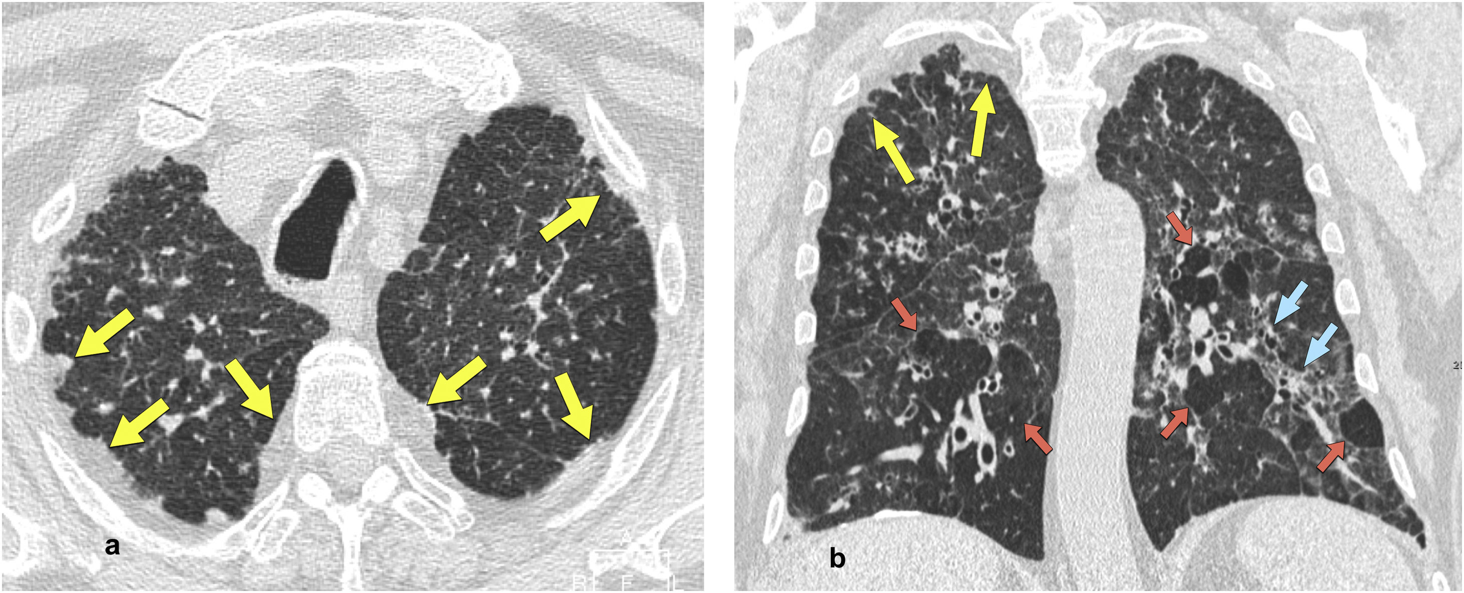 Ppfe Examples Idiopathic pleuroparenchymal fibroelastosis | Radiología (English Edition)