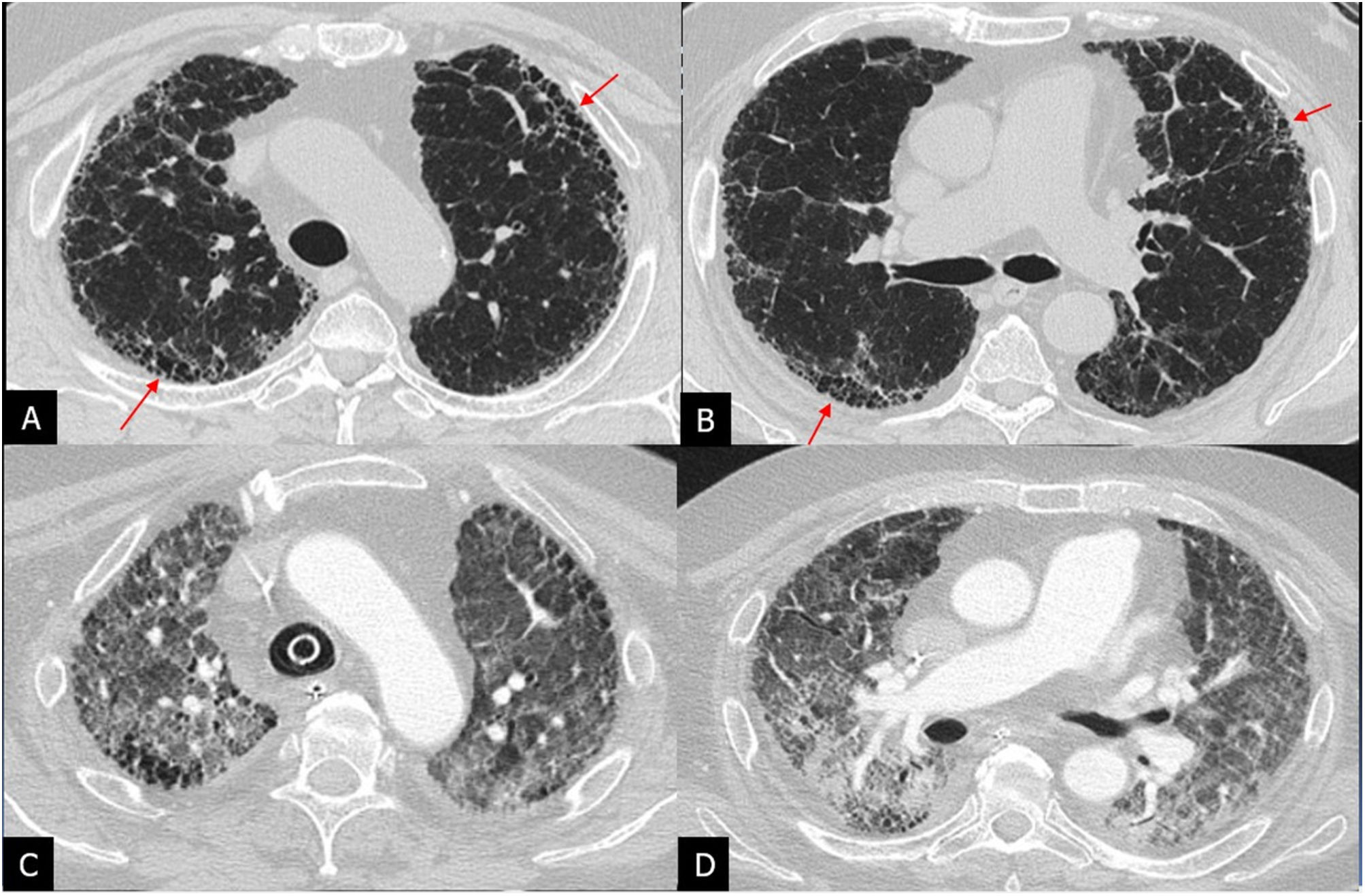 Ipf Radiopaedia Idiopathic pulmonary fibrosis | Radiología (English Edition)