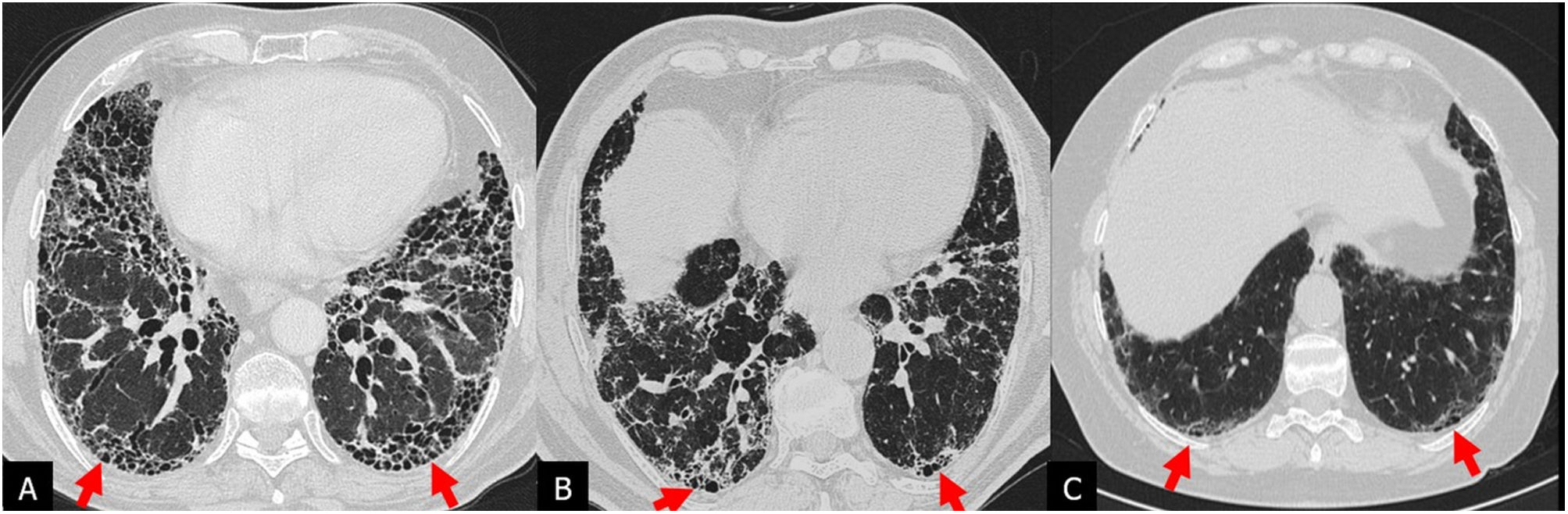 Uip Pattern Radiopaedia Idiopathic pulmonary fibrosis | Radiología (English Edition)