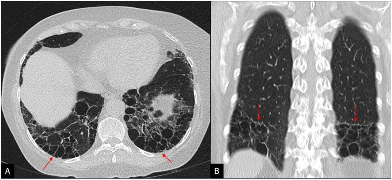 Idiopathic pulmonary fibrosis | Radiología (English Edition)