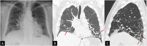 Chest radiograph (A) and high-resolution computed tomography (HRCT) with the volumetric acquisition in coronal (B) and sagittal (C) planes in a patient with idiopathic pulmonary fibrosis. The chest radiograph reveals peripheral reticular opacities, predominantly basal, which are indicative of interstitial lung disease, without characterisation of the pattern. HRCT reveals a pattern of usual interstitial pneumonia with traction bronchiolectasis and images of predominantly basal subpleural honeycombing (arrows).