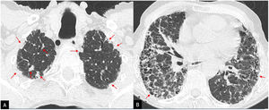 Pleuroparenchymal fibroelastosis associated with a pattern of usual interstitial pneumonia (UIP) in a patient with idiopathic pulmonary fibrosis. High-resolution computed tomography in the axial plane revealing apical pleuroparenchymal thickening in A (arrows) with a predominantly basal UIP pattern with honeycomb cysts in B (arrows).