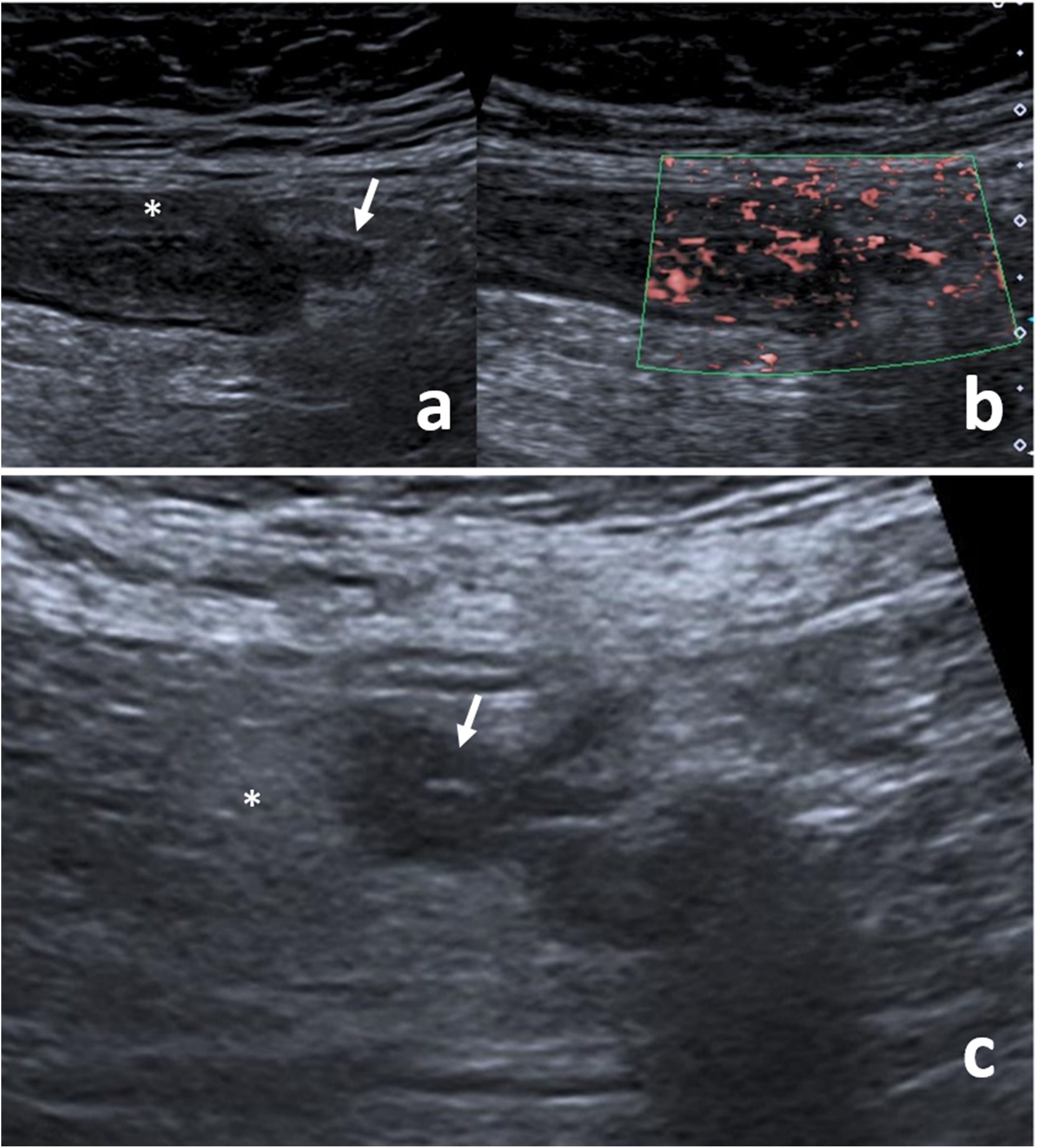 Classification of acute diverticulitis in the left colon with ...