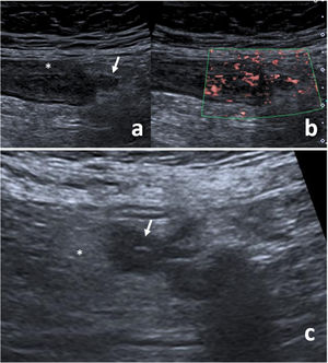 Ultrasound image of mild acute diverticulitis of the left colon. (A) A collapsed colon segment with (*) bowel wall thickening and hypoechogenicity of its wall; inflamed diverticulum (arrow). (B) Hypervascularisation of the walls of the inflamed colon and diverticulum in colour Doppler mode. (C) Increased echogenicity of the peridiverticular fat (*), corresponding to a peridiverticular phlegmonous area; diverticulum with thickened walls (arrow).
