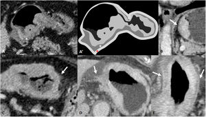 Depth of wall invasion (cT). A and A') GA cT1b in CT and drawing of the same slice. Polypoid thickening of gastric mucosa (black asterisk) with preservation of the hypodense submucosal layer (white asterisk). The red asterisk indicates the outermost tenuously hyperdense layer corresponding to the muscularis propria, subserosa and serosa. Post-surgery confirmation: pT1b. B) cT2. Gastric mural thickening with loss of the submucosal layer but a smooth border of the outer layer is visible. C) Mild blurring of the outer wall and minimal fat stranding. Possible cT3/T4a. Neoadjuvant chemotherapy was administered and surgery was performed. It proved to be a ypT3N0. D) cT4a: irregular wall surface with clear direct invasion of the fat. E) cT4a: diffuse gastric mural thickening with hyperattenuating serosa sign.