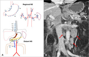 Lymph node involvement (cN). A) Diagram of nodal stations (NS) for gastric cancer, initially proposed by the Japanese Gastric Cancer Association (JGCA) and widely used today. Perigastric regional NS: right paracardial (1), left paracardial (2), lesser curvature (3), greater curvature (4), suprapyloric (5), infrapyloric (6). Extraperigastric regional NS: left gastric artery (7), common hepatic artery (8), coeliac artery (9), splenic hilum (10), splenic artery (11), hepatoduodenal ligament (12). Distant NS: posterior to pancreatic head (13), superior mesenteric vein (14v), transverse colon (15), para-aortic (16), anterior to the pancreatic head (17), inferior border of the pancreatic body (18), infradiaphragmatic along the subphrenic artery (19), paraesophageal in the diaphragmatic hiatus (20), paraesophageal in lower thorax (110), supradiaphragmatic (111), posterior mediastinum (112). If the gastric tumour invades the oesophagus, stations 19, 20, 110, and 111 are considered regional. Station 14v is considered regional in the JGCA classification and distant in the 8th AJCC classification. B) Subcardial GA with regional perigastric adenopathy (white arrows), extraperigastric adenopathy in the hepatic hilum (black arrow) and distant inter aorto-cava and para-aortic adenopathy (red arrows). The latter are compatible with cM1.