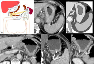 Subperitoneal dissemination. A) Illustration of the perigastric ligaments as possible routes of subperitoneal dissemination of gastric adenocarcinoma. GSL: gastrosplenic ligament; GCL: gastrocolic ligament; SRL: splenorenal ligament; GHL: gastrohepatic ligament; HDL: hepatoduodenal ligament; 1: neoplasm in cardia and lesser curvature; 2: antro-pyloric neoplasm; 3: neoplasm in greater curvature; 4: neoplasm in fundus and upper region of the greater curvature. B) Infiltration of the GHL: increased nodular density surrounding the left gastric vessels. B