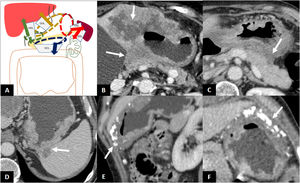 Direct invasion. A) Illustration of the perigastric ligaments as possible routes of direct invasion of gastric adenocarcinoma. B) Direct invasion of the left hepatic lobe and pancreatic body. C) Absence of fat plane between the stomach and the pancreatic body and tail indicating possible direct infiltration of the pancreas. Exploratory laparoscopy demonstrated absence of infiltration. D) Direct invasion of the spleen through the GSL. E and F) Thickening of the greater curvature of the stomach with calcifications and direct invasion of the GCL and greater omentum, without encroaching on the colon.