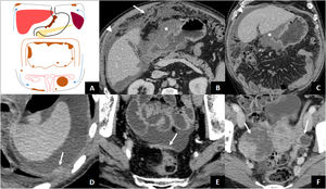 Transperitoneal dissemination. A) Illustration of a GA with transperitoneal spread presented with peritoneal carcinomatosis (subdiaphragmatic and pelvic implants, plaque of pelvic peritoneal thickening, omental cake) and Krukenberg tumour on the left. The arrows point to the direction of the ascites. B and C) Locally advanced antro-pyloric GA (asterisks), diffuse type with signet ring cells, with peritoneal carcinomatosis: ascites (arrowheads) and striking omental thickening or omental cake (arrow). D) Left subdiaphragmatic peritoneal implant (arrow) and ascites indicating tumour recurrence of the operated GA. E) Peritoneal thickening in hyperintense plaque (arrow) due to peritoneal carcinomatosis. F) Diffuse type GA with signet ring cells with bilateral Krukenberg tumour (arrows).