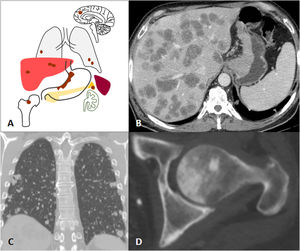 Haematogenous dissemination. A) Illustration of the most frequent sites of GA metastases. B-D) Subcardial and lesser curvature GA with liver, lung and left femoral head metastases at diagnosis.
