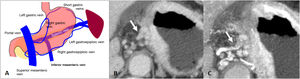 Extramural venous invasion. A) Illustration of the gastric venous system. B) Diffuse gastric adenocarcinoma with EVI of the left gastric vessels in the gastrohepatic ligament (arrow). C) Same case as in B with MIP reconstruction of the arterial phase, where the tubular thickening of the left gastric vein is more evident.