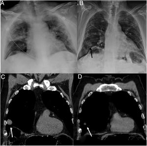 A) Chest radiograph showing bilateral alveolar involvement in relation to COVID-19 pneumonia. (B) Chest radiograph showing improvement of alveolar involvement and the appearance of a pulmonary nodule in the middle lobe (arrow). C) Coronal computed tomography (CT) reconstruction on the mediastinal window setting showing a hyperdense nodule in the middle lobe (arrow). D) Coronal CT reconstruction on the mediastinal window setting of the same patient five months later, with a reduced pulmonary nodule both in size and density (3 HU) (arrow).