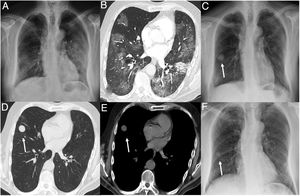 A) Chest radiograph showing bilateral faint opacities and consolidation in relation to COVID-19 pneumonia. B) Axial computed tomography (CT) image in lung window setting showing bilateral ground-glass opacities and focal consolidation in the left lower lobe. C) Follow-up radiograph one month after hospital discharge showing a smooth-edged nodule in the middle lobe (arrow). D and E) Axial CT images in lung and mediastinal window settings respectively, showing a hypodense pulmonary nodule (5 HU) in the middle lobe (arrow). F) Chest radiograph after six months indicating the reduced size of the pulmonary nodule (arrow).