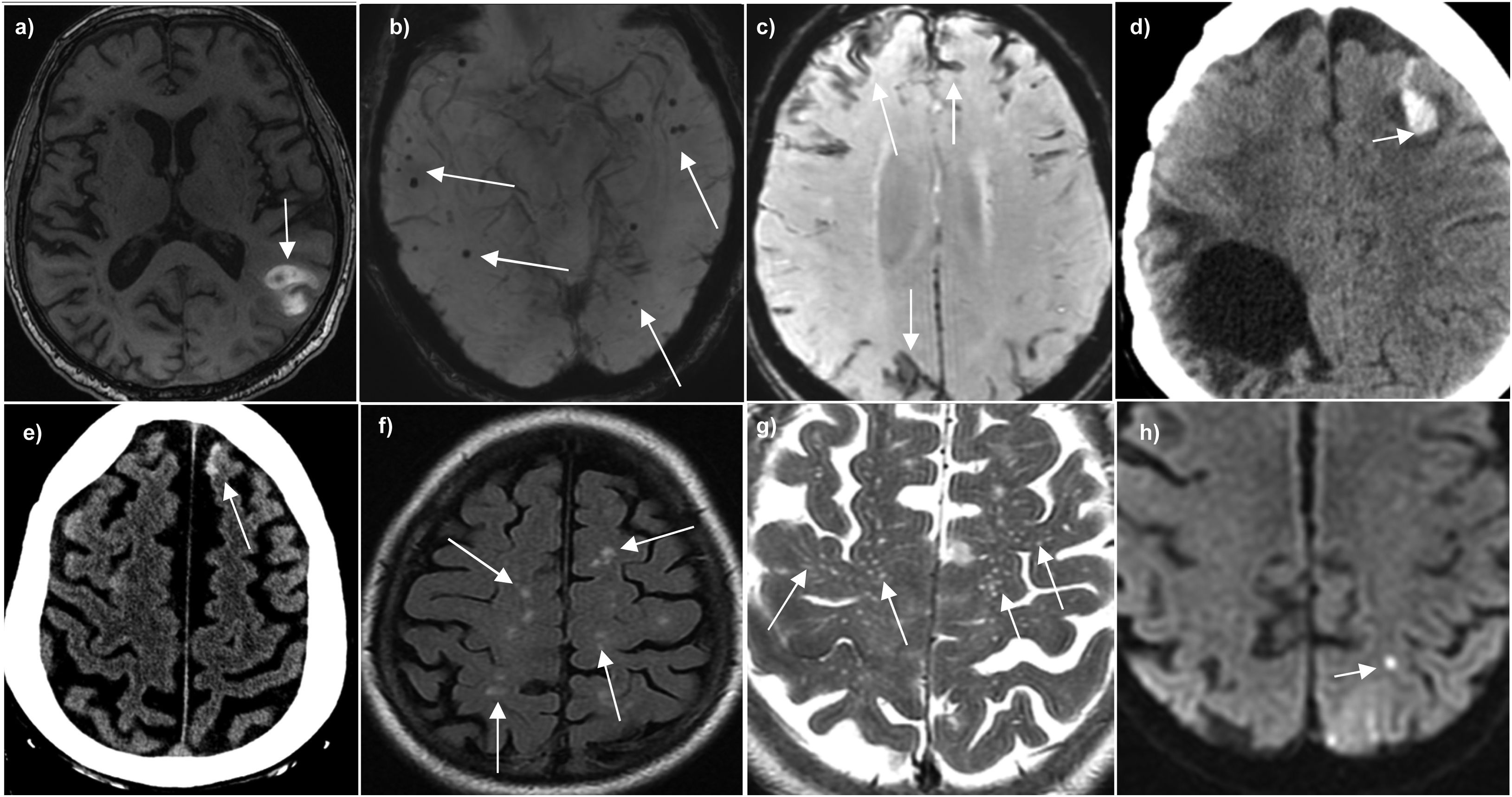 Primary and secondary non-traumatic intra-cerebral haemorrhage: MRI ...