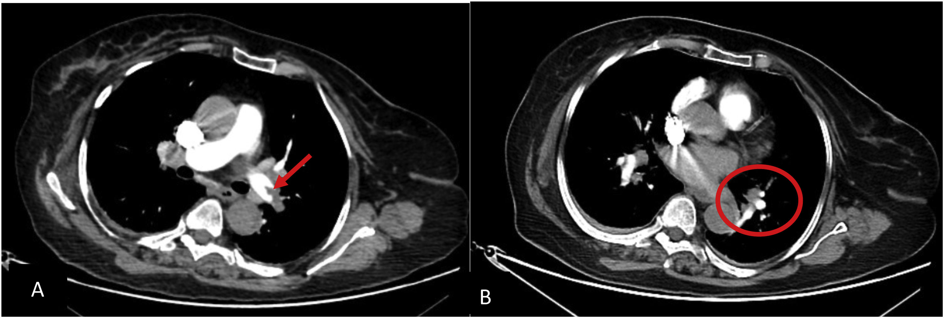 Pulmonary artery obstruction index, pulmonary artery diameter and right ...
