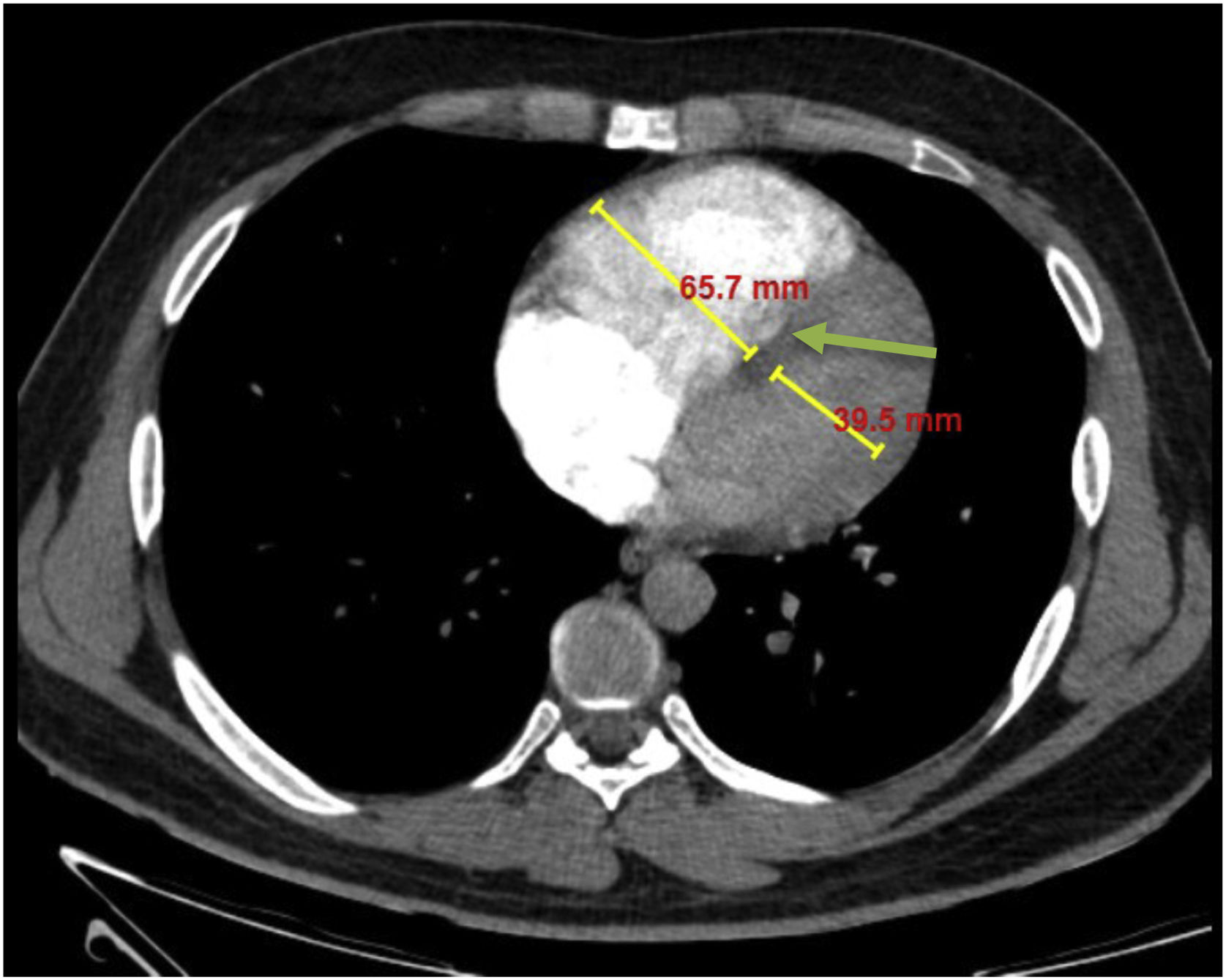 Pulmonary artery obstruction index, pulmonary artery diameter and right ...